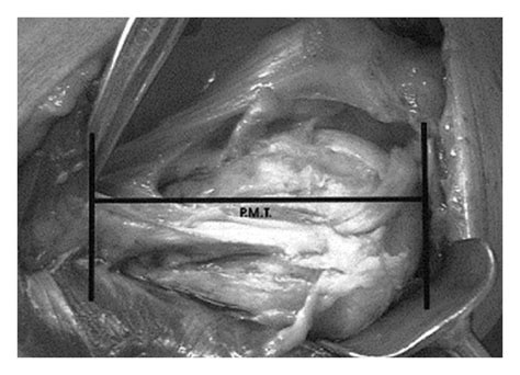 It is composed of three parts named for their origins tall, thin women have them more vertically oriented. The average distance from the pectoralis major tendon (PMT ...