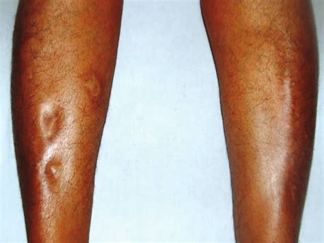 Lower Limb Edema Examination Displaying Pitting Edema Of The Lower Leg My XXX Hot Girl