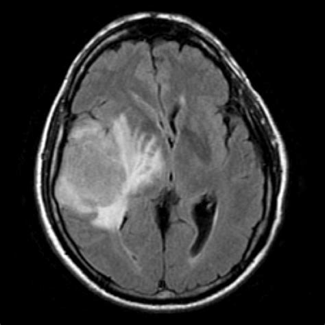 Structural Lesion In Brain Brain Lesions Symptoms Causes Treatments