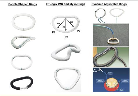 Summary Of The Most Recent Advancements In Mitral Annuloplasty Ring