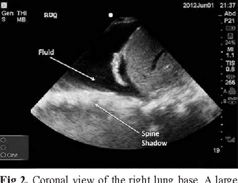 Pdf The Thoracic Spine Sign In Bedside Ultrasound Three Cases Report