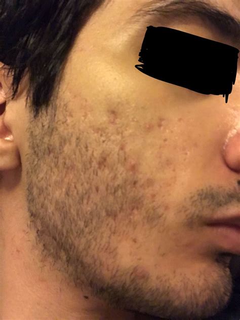How Severe Is My Acne Scars What To Do About It Scar Treatments