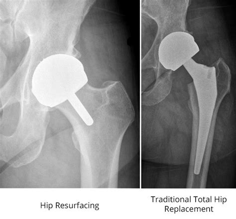 Hip Surgery And Replacement Midwest Bone Joint Center