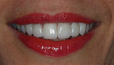 Instant Orthodontics Using Veneer To Correct Crowding Teeth Pictures