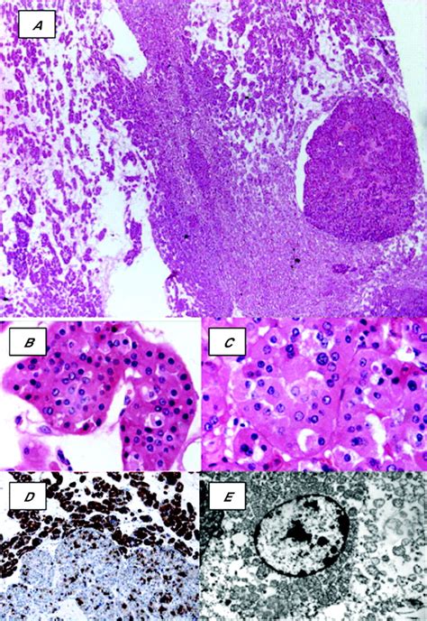 Metastatic Renal Oncocytoma Journal Of Clinical Pathology