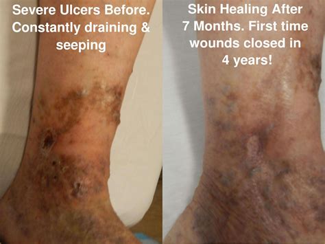 Varicose Vein Treatment Before And After Photos Varicose Vein