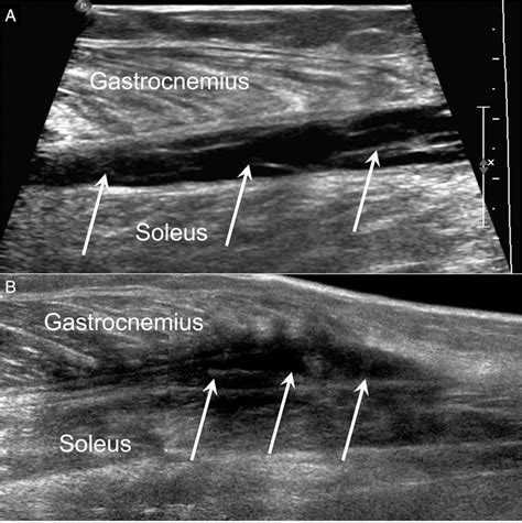 Its Not All Deep Vein Thrombosis Sonography Of The Painful Lower