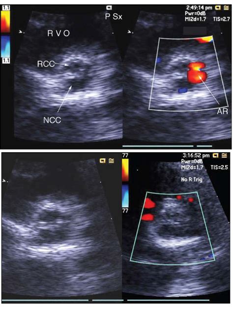Severe Aortic Insufficiency Seen On Transthoracic Echocardiography