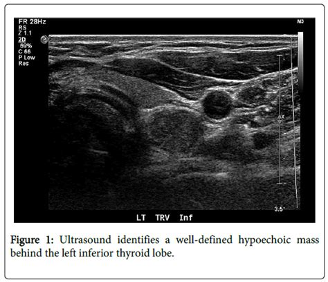 Thyroid Disorders Therapy Ultrasound Identifies