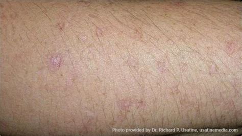 Skin Cancer Lesions On Arms Ccf