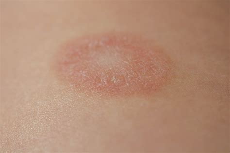 What Causes A Maculopapular Rash Facty Health