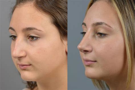 Nose Surgery Before And After Patient 28 Dr Marotta