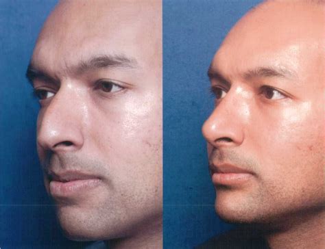 The Nose Clinic Before And After Nose Surgery Photos 49