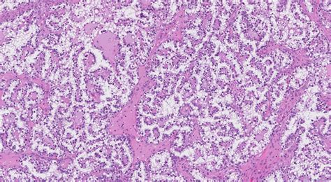 Clear Cell Carcinoma Of The Ovary Atlas Of Pathology