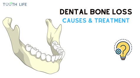 Bone Loss In Teeth And Your Treatment Options