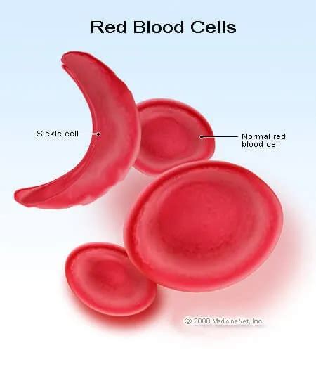 Sickle Cell Anemia Symptoms Treatment Causes And Inheritance