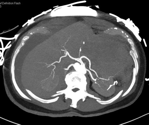 Splenic Rupture With Hemoperitoneum In Patient With Lung Cancer Liver