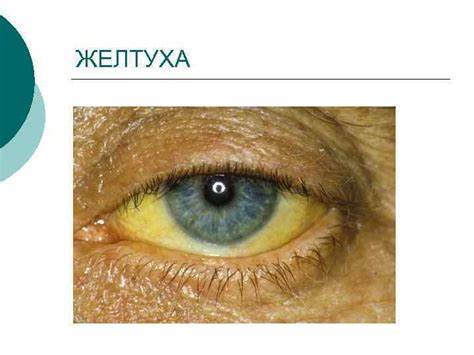 Хронический гепатит диета 5 ТЕМА: ХРОНИЧЕСКИЕ ГЕПАТИТЫ. ХРОНИЧЕСКИЙ ГЕПАТИТ- ХРОНИЧЕСКОЕ ВОСПАЛЕНИЕ ТЕМА: ХРОНИЧЕСКИЕ ГЕПАТИТЫ. ХРОНИЧЕСКИЙ ГЕПАТИТ- ХРОНИЧЕСКОЕ ВОСПАЛЕНИЕ Хронический гепатит диета 5