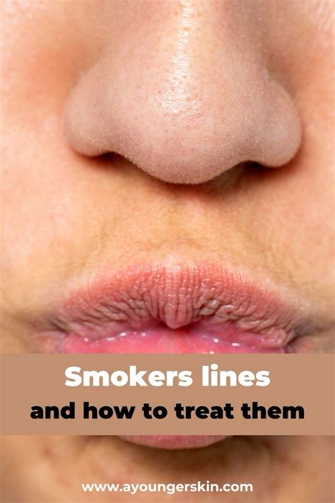 Smokers Lines Why You Get Them And How To Treat Them A Younger Skin