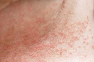 Terms in this set (15). Heat rash, sun rash -- what's the difference? | OSF HealthCare