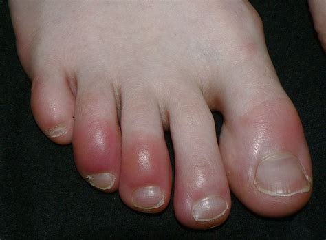 Are Covid Toes A Symptom Of Coronavirus Dermatologists Weigh In