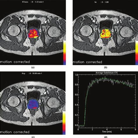 Dynamic Contrast Enhanced Mri Images Of The Pelvis With Overlayed
