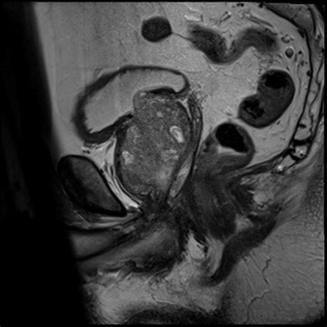 Prostate Adenocarcinoma Apical Nodule On Mri Pi Rads 3 Image