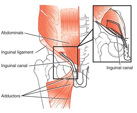 Groin Muscle Anatomy Male Inguinal Hernia Surgery Symptoms And Causes