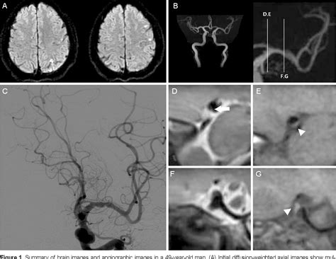 Figure 1 From Spontaneous Middle Cerebral Artery Dissection With Distal