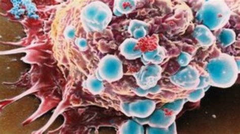 Kajian Baru Soal Kanker Payudara Bbc News Indonesia