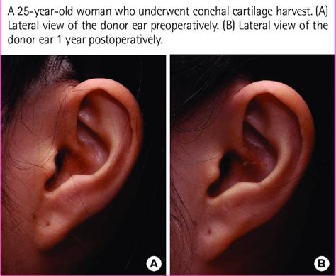 Ear Cartilage Rhinoplasty