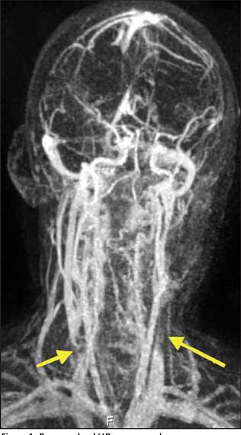 Figure 1 From Chronic Cerebrospinal Venous Insufficiency A New Paradigm