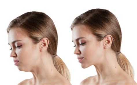 Jaw Surgery Before And After What Happens After Jaw Surgery