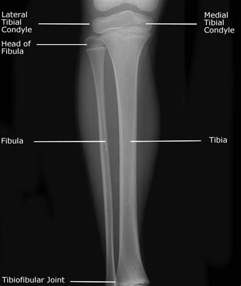 Radiographic Positioning Tibia Fibula