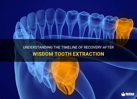 Understanding The Timeline Of Recovery After Wisdom Tooth Extraction