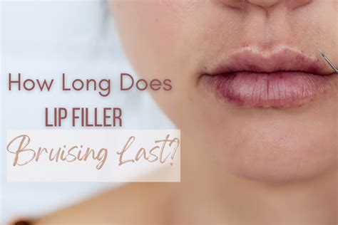 Bruised But Beautiful How Long Does Lip Filler Bruising Last