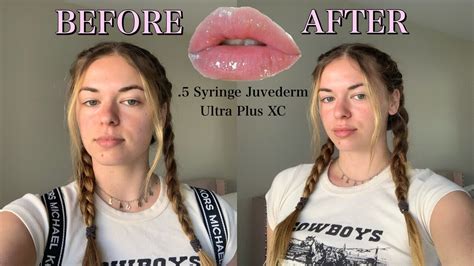Getting 05 Syringe Of Juvederm Ultra Plus Xc Before During And After