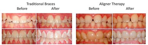 White Spot Lesions Orthodontics