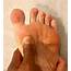 Could Your Nagging Foot Pain Be Sesamoiditis
