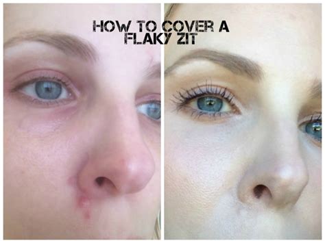 How To Cover Up A Flaky Pimple Beautynow Blog