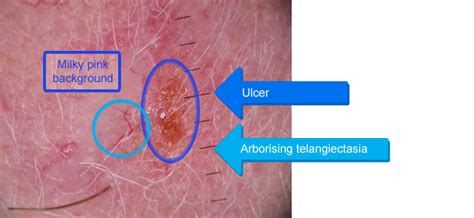 Diagnosis And Management Of Non Melanoma Skin Cancer