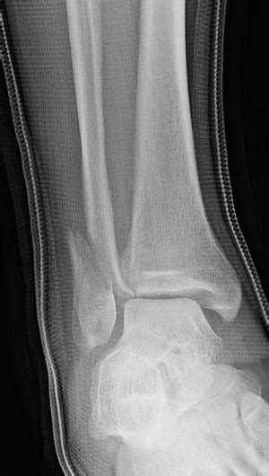Broken Ankle Types Of Fractures Diagnosis And Treatments Hss