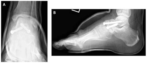 Osteoarthritis Of The Talonavicular Joint With Pseudarthrosis Of The