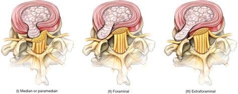 Surgical Treatment Of Far Lateral Lumbar Disc Herniation A Safe And