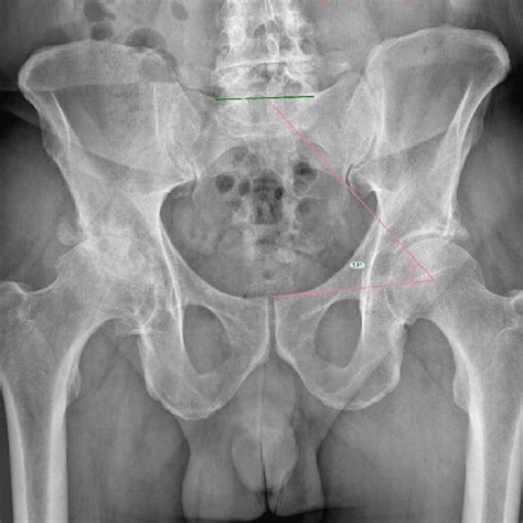 Pelvic Tilt Measured On A Standing Lateral Pelvis Radiograph The Two