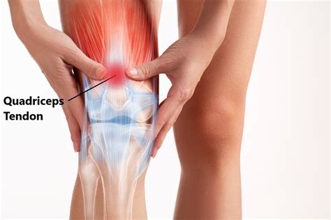 Thigh Muscle Strain Motion Health Centre
