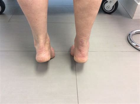 A Closer Look At New Developments In Treating Achilles Tendon Ruptures