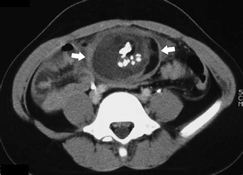 Atypical Ct And Mri Manifestations Of Mature Ovarian Cystic Teratomas Ajr