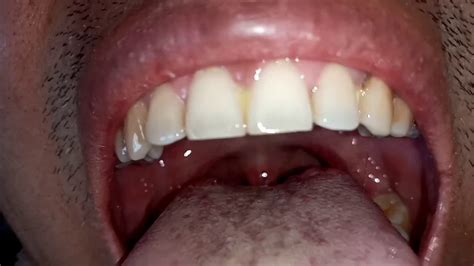 Canker Sore On Uvula Pregnant Center Informations