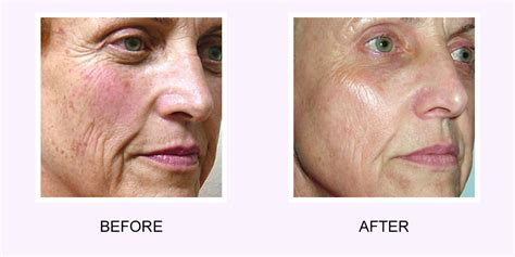 Softer Smoother And Healthier Skin With Photo Rejuvenation